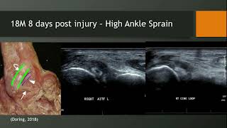 Ultrasound High Ankle Sprain Part 3 Tutorial [upl. by Genesia]