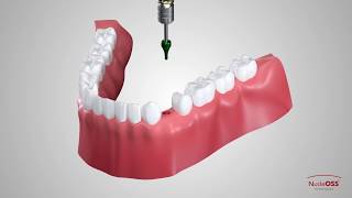 Single Crown Restoration With T6 Standart Abutment [upl. by Strep]