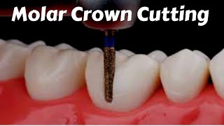 Posterior molar Crown ToothPreparation Cutting For PFM Zirconia Ceramic Emax  Prostho Lecture [upl. by Buroker394]