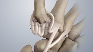 Osteoarthritis of the Thumb Surgical Treatment LRTI [upl. by Hameean]