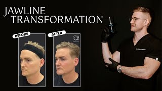 AOTV Male Aesthetics  Chin amp Jawline Enhancement Part 1 of 3 [upl. by Ayit]