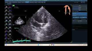 IQ 315 AUTOEF PYOMETRA ECHOPAC ANALYSIS ECHOCARDIOGRAPHY [upl. by Ardnuhs521]