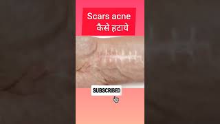 Mederma cream for acne scars viral shorts [upl. by Duthie525]