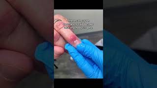 What is a Digital Mucous Cyst Derm Explination ✨🖐🏼 NailCare Cyst [upl. by Nicolis141]