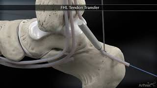 Flexor Hallucis Longus FHL Tendon Transfer [upl. by Yecac]