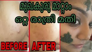 How To Remove Pimples Naturally 😱Overnight How to Get Rid Of Pimples [upl. by Larrabee]