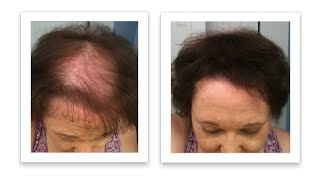 Hair Thinning in Women [upl. by Fulmer]