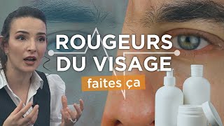 ROUGEURS autour des sourcils du nez Voila comment SOIGNER la dermite seborrhéique [upl. by Brew316]