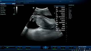 Achondroplasia ultrasound findings Diagnostic ultrasound cases [upl. by Milone]