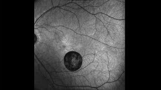 Pigmented Vitreous Cyst Within the Posterior Precortical Vitreous Pocket [upl. by Aratahs854]