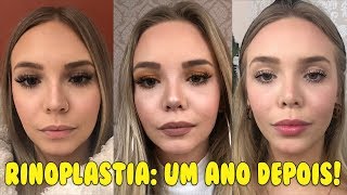 RINOPLASTIA RESULTADO FINAL APÓS UM ANO ANTES x DEPOIS [upl. by Anilyx]