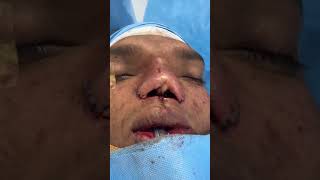 Columellar and Nasal Redo Reconstruction for Tessier Hyper teleroism plasticsurgery [upl. by Aleik]