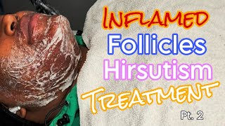 Inflamed Follicles Hirsutism Treatment Skincare wextractions pt 2 FOLLOWUP [upl. by Dodd]