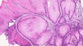 OPath Verrucous Hyperplasia vs Verrucous Carcinoma  by Dr Mithilesh Chandra [upl. by Robinet676]