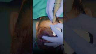 Temporal hairline restoration Elrevo clinic  Hair Transplant [upl. by Helsa]