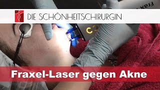 Akne Behandlung mit Fraxel Laser [upl. by Joela]