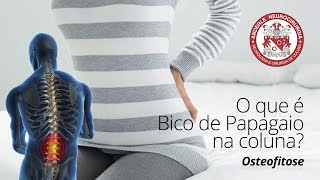 O que é BICO de PAPAGAIO na Coluna ou OSTEOFITOSE  Dr Diogo Neurocirurgião [upl. by Leyes]