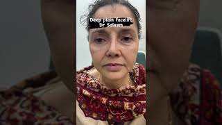 Best deep plain facelift amp Necklift surgery by dr Saleem V shaping in Pakistan [upl. by Kato20]