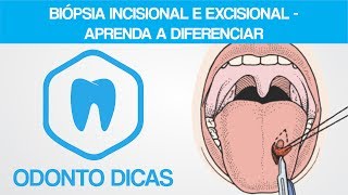 BIÓPSIA INCISIONAL E EXCISIONAL  APRENDA A DIFERENCIAR  ODONTO DICAS [upl. by Kerby530]