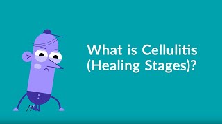 Cellulitis Healing Stages [upl. by Htepsle]