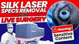 SiLK Laser Specs Removal  Near LIVE Surgery by Dr Rahil Chaudhary [upl. by Estella404]