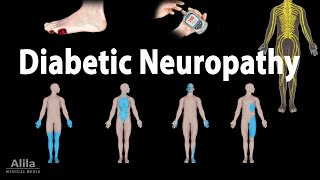 Diabetic Neuropathy Animation [upl. by Lucier]