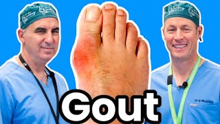 Do You Have Gout Heres How To Diagnose Treat and Prevent It [upl. by Netsua]