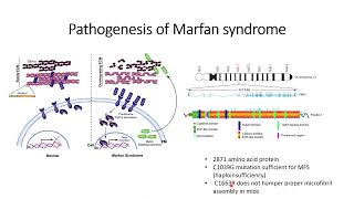 Marfan Syndrome Genetic Disorder Code 209 [upl. by Anert]