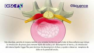 TRATAMIENTO DE HERNIAS DISCALES POR NUCLEOPLASTIA CON DISCFX [upl. by Eggett]