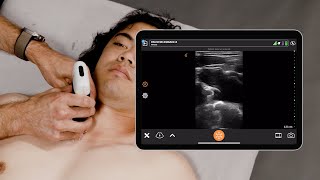 Ultrasound for Subclavian Central Line Placement [upl. by Rudwik370]