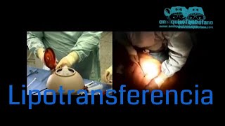 Todo lo que hay que saber de la lipotransferencia [upl. by Jezreel]