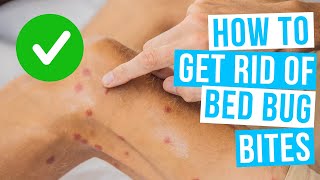 How to GET RID OF BED BUG BITES overnight [upl. by Adlei]