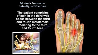 Mortons Neuroma  Interdigital Neuroma  Everything You Need To Know  Dr Nabil Ebraheim [upl. by Weiman245]