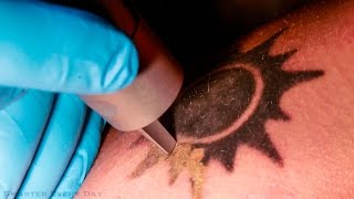 How Laser Tattoo Removal Works  Smarter Every Day 123 [upl. by Namlak]