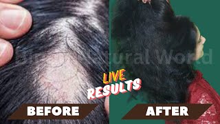 Receding Hairline Regrowth  Hair Regrowth at 40  Regrow Hair After 40 Going Natural from Chemical [upl. by Ozzy]