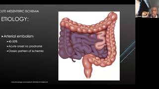 Mesenteric Ischemia [upl. by Arber]