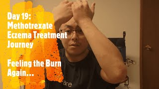 Day 19  Methotrexate Eczema Treatement Journey Feeling the Burn Again [upl. by Atilol]