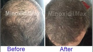 I’ve Used Minoxidil For 10 Years  Here Are The Results hair [upl. by Enirehtacyram]