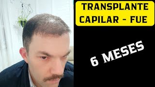 TRANSPLANTE CAPILAR  FUE 6 MESES  ESTOU SATISFEITO COM O RESULTADO [upl. by Talya285]