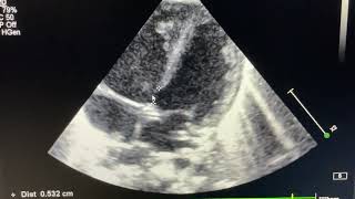 Partial AV septal Defect with Ostium Secundum ASD [upl. by Etak146]