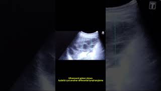 Splenic hydatid cyst or lymphangioma [upl. by Aeslahc452]