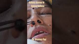 How to apply Kshara in Conca Bullosa dr shamsa fiaz nia ent ksharakarma parasurgical [upl. by Judah976]