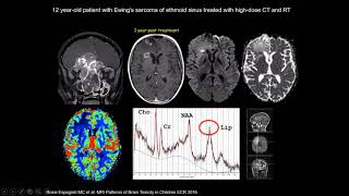 International Cancer Imaging Society Oct 17 Imaging of radiation induced CNS toxicity G Morana [upl. by Leicam395]