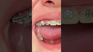 Braces On  Rotation Wedges  Toothtime Family Dentistry Orthodontics New Braunfels tx [upl. by Haron]