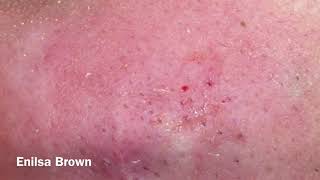 Blackheads Extractions Christian Part 2 [upl. by Nauq]