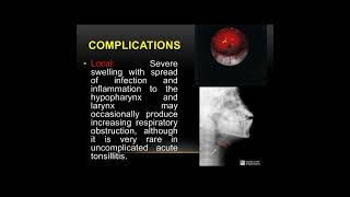 Tonsillitis Definition of tonsillitis  Causes of tonsillitis Symptoms of tonsillitis✨ [upl. by Scutt561]