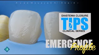 diastema closure technique tips [upl. by Drof267]