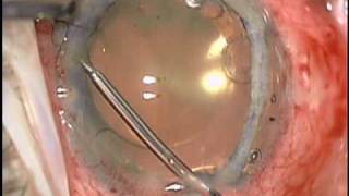 Baseer U Khan MD Dislocated Cataract Extraction CTS Iridodialysis Repair and Pupil Cerclage [upl. by Tana]