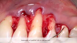 How to apply hyaluronic acid when treating a gingivalgum recession [upl. by Aititel]