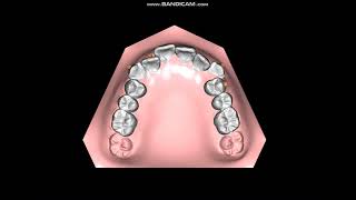 How Invisalign Works [upl. by Leuqer]